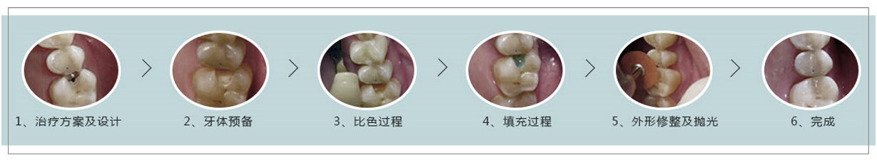 美国3M树脂补牙技术